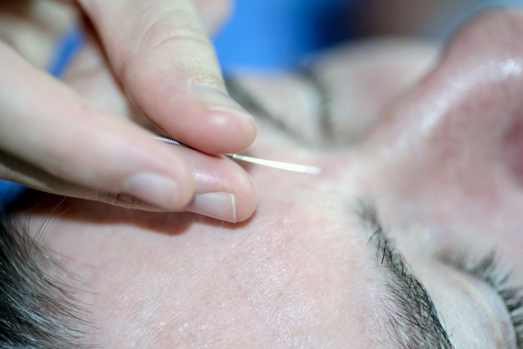 Acupuncture for Tinnitus